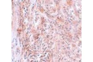 Immunohistochemistry of BCAS2 in human breast carcinoma with BCAS2 antibody at 5 μg/ml. (BCAS2 antibody  (C-Term))