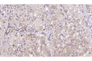 ABIN6273315 at 1/100 staining Human thyroid cancer tissue by IHC-P. (SEC63 antibody  (C-Term))