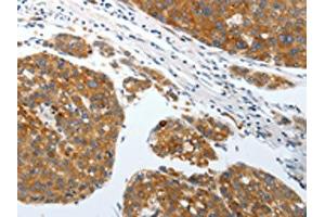 The image on the left is immunohistochemistry of paraffin-embedded Human liver cancer tissue using ABIN7192428(SLC22A3 Antibody) at dilution 1/25, on the right is treated with synthetic peptide.