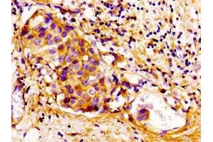 Immunohistochemistry of paraffin-embedded human breast cancer using ABIN7148919 at dilution of 1:100 (CDKN3 antibody  (AA 1-172))