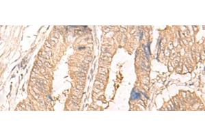 Immunohistochemistry of paraffin-embedded Human colorectal cancer tissue using IL24 Polyclonal Antibody at dilution of 1:30(x200)