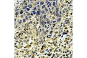 Immunohistochemical analysis of ABO staining in human esophageal cancer formalin fixed paraffin embedded tissue section. (ABO antibody)