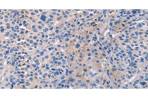 Immunohistochemistry of paraffin-embedded Human liver cancer tissue using CD5L Polyclonal Antibody at dilution 1:40 (CD5L antibody)
