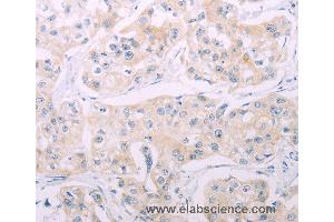 Immunohistochemistry of Human breast cancer using ADCY7 Polyclonal Antibody at dilution of 1:60 (ADCY7 antibody)