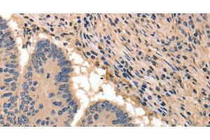 Immunohistochemistry of paraffin-embedded Human colon cancer tissue using BAIAP2 Polyclonal Antibody at dilution 1:50 (BAIAP2 antibody)