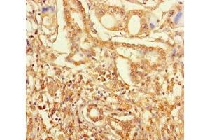Immunohistochemistry of paraffin-embedded human pancreatic cancer using ABIN7176457 at dilution of 1:100 (ZNF627 antibody  (AA 1-300))