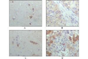 Immunohistochemical analysis of paraffin-embedded human brain hippocampus (A), lung cancer (B), brain tumor (C), breast cance (D), showing cytoplasmic localization with DAB staining using CRYAB mouse mAb. (CRYAB antibody  (AA 1-175))