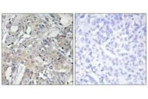 Immunohistochemistry analysis of paraffin-embedded human breast carcinoma tissue using Collagen VI α3 antibody. (COL6a3 antibody)