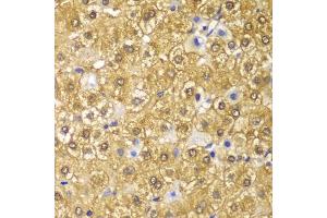 Immunohistochemistry of paraffin-embedded human liver cancer using CCND1 antibody (ABIN2736604) at dilution of 1:100 (40x lens). (Cyclin D1 antibody)