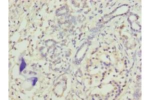 Immunohistochemistry of paraffin-embedded human pancreatic cancer using ABIN7172914 at dilution of 1:100 (TRAM2 antibody  (AA 316-370))
