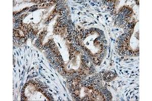 Immunohistochemical staining of paraffin-embedded Adenocarcinoma of colon tissue using anti-NIT2 mouse monoclonal antibody.