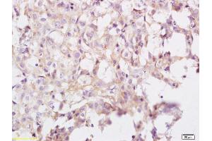 Formalin-fixed and paraffin embedded human breast carcinoma labeled with Anti eIF3A Polyclonal Antibody, Unconjugated (ABIN704891) at 1:200 followed by conjugation to the secondary antibody and DAB staining