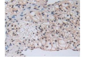 IHC-P analysis of Human Kidney Cancer Tissue, with DAB staining.
