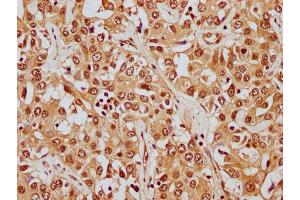 IHC image of nphHU diluted at 1:8 and staining in paraffin-embedded human liver cancer performed on a Leica BondTM system. (HIST1H1E antibody  (AA 21-33))