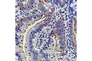 Immunohistochemical analysis of Ribophorin-1 staining in human colon cancer formalin fixed paraffin embedded tissue section. (RPN1 antibody)
