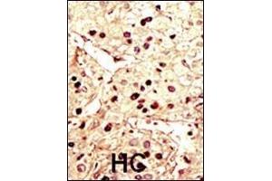 Formalin-fixed and paraffin-embedded human cancer tissue reacted with the primary antibody, which was peroxidase-conjugated to the secondary antibody, followed by DAB staining. (Aurora-B (ARK/STK12) (AA 6-35), (N-Term) antibody)