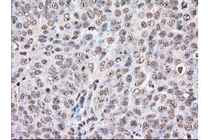 Immunohistochemical staining of paraffin-embedded Adenocarcinoma of Human colon tissue using anti-BAT1 mouse monoclonal antibody.