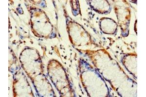 Immunohistochemistry of paraffin-embedded human gastric cancer using ABIN7166961 at dilution of 1:100 (RABGAP1L antibody  (Isoform 10))