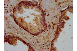 IHC image of ABIN7157575 diluted at 1:400 and staining in paraffin-embedded human prostate cancer performed on a Leica BondTM system. (KIFAP3 antibody  (AA 660-792))