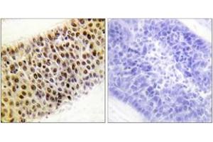 Immunohistochemistry analysis of paraffin-embedded human liver carcinoma tissue, using TIP60 (Ab-86) Antibody. (KAT5 antibody  (AA 52-101))