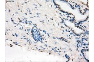 Immunohistochemical staining of paraffin-embedded Adenocarcinoma of colon tissue using anti-MAP2K1 mouse monoclonal antibody. (MEK1 antibody)