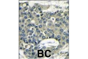 Formalin-fixed and paraffin-embedded human breast carcinoma reacted with EIF4B Antibody (C-term) (ABIN6242301 and ABIN6577381) , which was peroxidase-conjugated to the secondary antibody, followed by DAB staining. (EIF4B antibody  (C-Term))