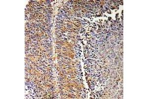 Immunohistochemical analysis of SH2D2A staining in human liver cancer formalin fixed paraffin embedded tissue section. (SH2D2A antibody)
