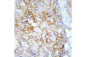 Immunohistochemical analysis of paraffin-embedded human lung adenocarcinoma tissue using FGFR1 (phospho Tyr154) polyclonal antibody . (FGFR1 antibody  (pTyr154))