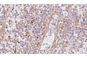 ABIN6273202 at 1/100 staining Human lymph cancer tissue by IHC-P.