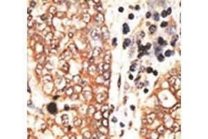 IHC analysis of FFPE human hepatocarcinoma tissue stained with the NRG2 antibody (Neuregulin 2 antibody  (AA 830-855))