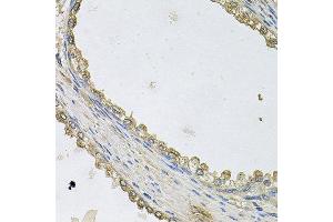 Immunohistochemistry of paraffin-embedded human prostate using MTERFD1 antibody at dilution of 1:100 (x40 lens).