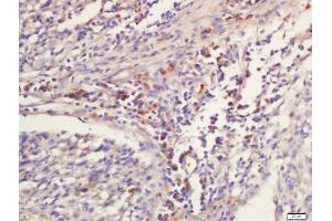 paraformaldehyde-fixed, paraffin embedded human laryngocarcinoma tissue; Antigen retrieval with 0. (GNLY antibody  (AA 23-120))