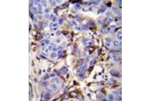 Immunohistochemistry analysis in formalin fixed and paraffin embedded human breast carcinoma reacted PIP / GCDFP15 Antibody (C-term) followed by peroxidase conjugation of the secondary antibody and DAB staining. (PIP antibody  (C-Term))
