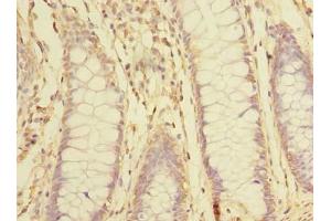 Immunohistochemistry of paraffin-embedded human colon cancer using ABIN7170360 at dilution of 1:100 (SNX16 antibody  (AA 1-342))