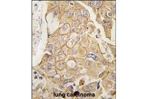 Formalin-fixed and paraffin-embedded human lung carcinoma tissue reacted with ADCY2 antibody (C-term) (ABIN389223 and ABIN2839376) , which was peroxidase-conjugated to the secondary antibody, followed by DAB staining. (ADCY2 antibody  (C-Term))