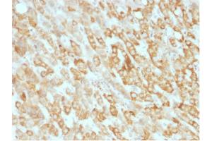 Formalin-fixed, paraffin-embedded human Hepatic Carcinoma stained with Prohibitin Mouse Monoclonal Antibody (SPM311). (Prohibitin antibody  (AA 167-261))