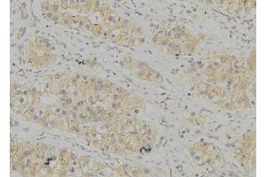 ABIN6272936 at 1/100 staining Human breast cancer tissue by IHC-P. (AP3B1 antibody  (C-Term))