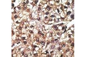 IHC analysis of FFPE human hepatocarcinoma tissue stained with the PINK1 antibody (PINK1 antibody  (AA 118-147))