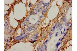 Immunohistochemistry analysis of human pancreatic cancer using ABIN7169051 at dilution of 1:100 (ICK antibody  (AA 150-275))