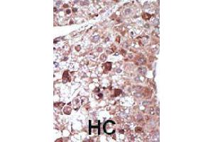 Formalin-fixed and paraffin-embedded human hepatocellular carcinoma tissue reacted with PCK1 polyclonal antibody  , which was peroxidase-conjugated to the secondary antibody, followed by DAB staining. (PCK1 antibody  (N-Term))