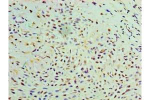 Immunohistochemistry of paraffin-embedded human breast cancer using ABIN7174611 at dilution of 1:100