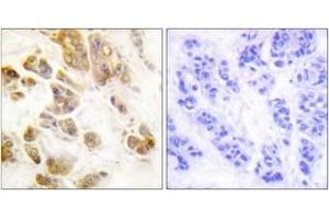 Immunohistochemistry analysis of paraffin-embedded human breast carcinoma, using CaMK1-alpha (Phospho-Thr177) Antibody. (CAMK1 antibody  (pThr177))