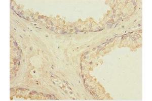 Immunohistochemistry of paraffin-embedded human prostate cancer using ABIN7158367 at dilution of 1:100 (LMO4 antibody  (AA 1-165))