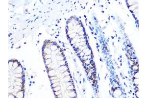 Immunohistochemistry of paraffin-embedded human colon using MT Rabbit mAb (ABIN1679683, ABIN7101713, ABIN7101714 and ABIN7101715) at dilution of 1:100 (40x lens). (MTA2 antibody)