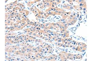 The image on the left is immunohistochemistry of paraffin-embedded Human lung cancer tissue using ABIN7128234(ADAM32 Antibody) at dilution 1/15, on the right is treated with fusion protein. (ADAM32 antibody)
