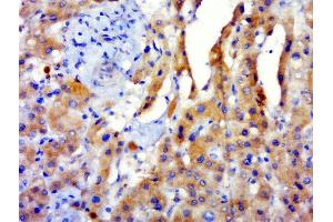 Paraformaldehyde-fixed, paraffin embedded human hepatocellular carcinoma tissue, Antigen retrieval by boiling in sodium citrate buffer(pH6) for 15min, Block endogenous peroxidase by 3% hydrogen peroxide for 30 minutes, Blocking buffer (normal goat serum) at 37°C for 20min, Antibody incubation with Rabbit Anti-GPATCH3 Polyclonal Antibody, Unconjugated  at 1:500 overnight at 4°C, followed by a conjugated secondary and DAB staining (GPATCH3 antibody  (AA 331-430))