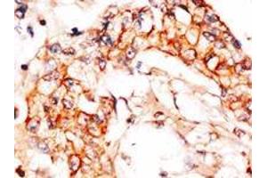 Formalin-fixed and paraffin-embedded human breast carcinoma reacted with anti-APPBP1 (C-term), which was peroxidase-conjugated to the secondary antibody, followed by DAB staining.