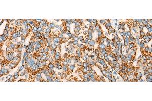 Immunohistochemistry of paraffin-embedded Human liver cancer tissue using CHCHD3 Polyclonal Antibody at dilution of 1:45(x200) (CHCHD3 antibody)