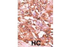 Immunohistochemistry (IHC) image for anti-Signal Transducer and Activator of Transcription 5A (STAT5A) (pSer726) antibody (ABIN2970978) (STAT5A antibody  (pSer726))