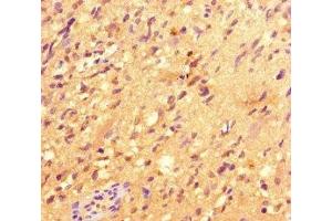 Immunohistochemistry of paraffin-embedded human glioma using ABIN7147801 at dilution of 1:100 (IRG1 antibody  (AA 57-257))